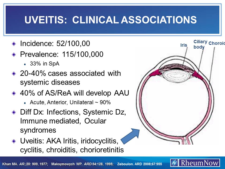 Pathophysiology Of Uveitis