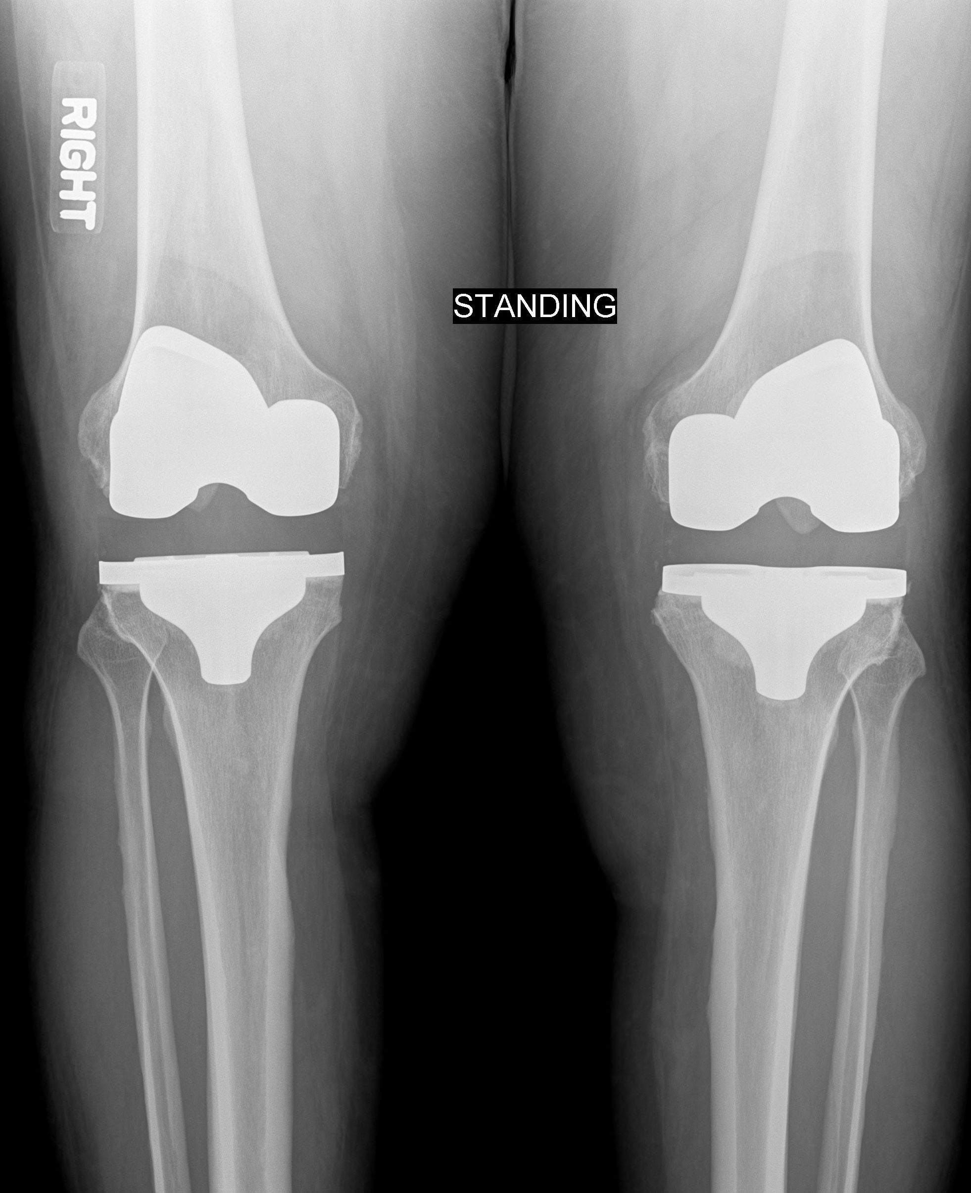 Simultaneous Versus Staged Bilateral Total Knee Arthroplasty Rheumnow