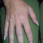 Early arthritis of the hand