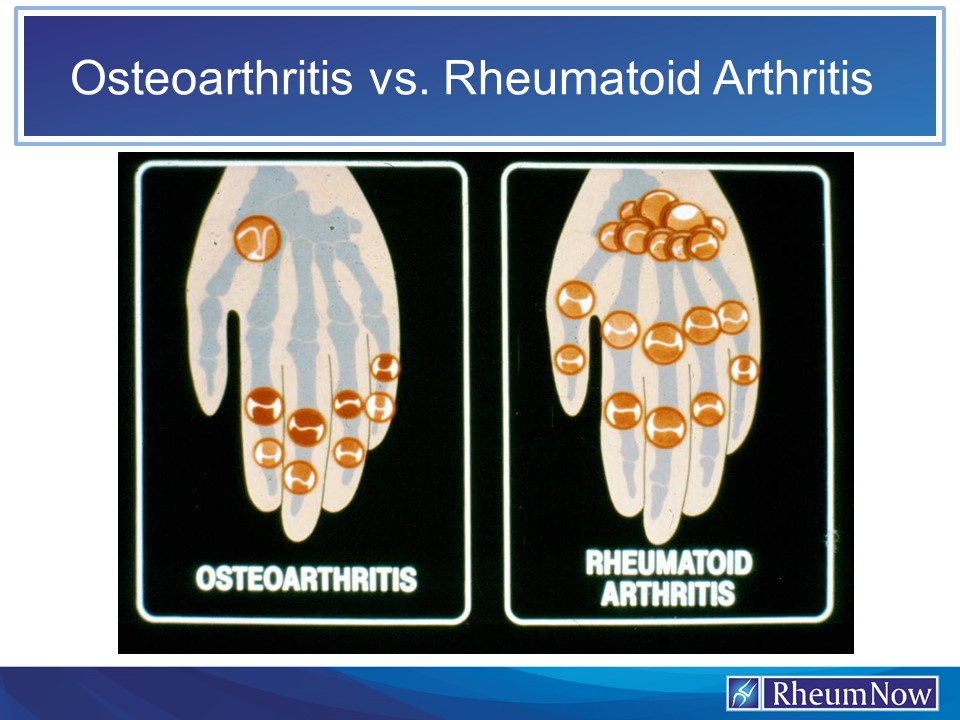 Osteoarthritis Compared To Rheumatoid Arthritis Doctorvisit