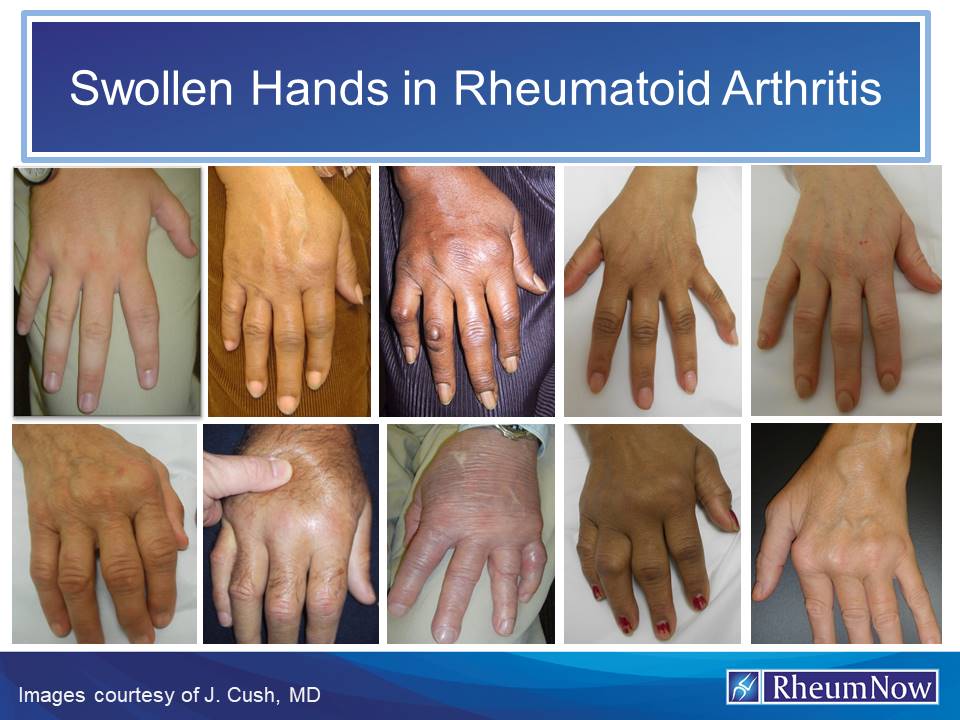 Swollen Hands In Rheumatoid Arthritis RheumNow