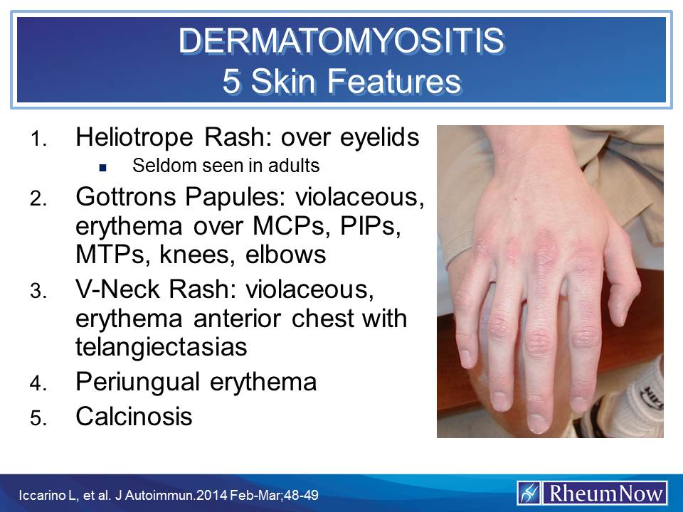 Cutaneous Manifestations Of Dermatomyositis A Comprehensive Review | My ...