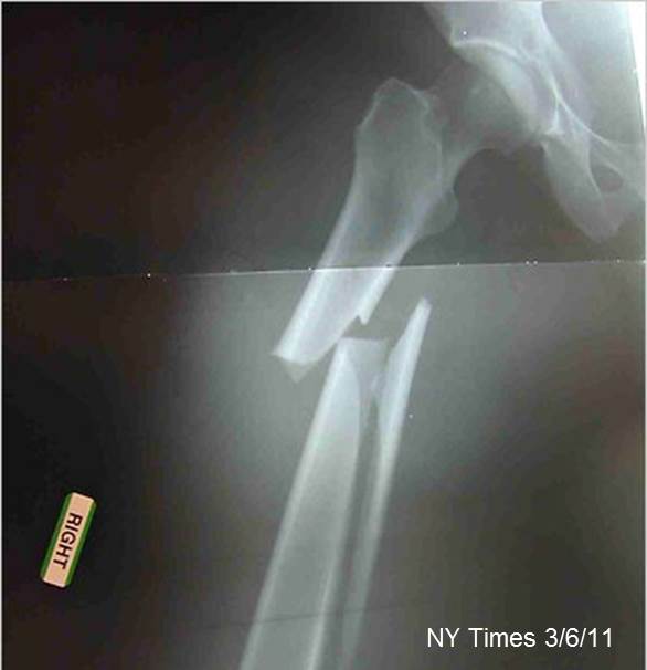 Do we need Better Strategies to Prevent Osteoporotic Fractures? Save