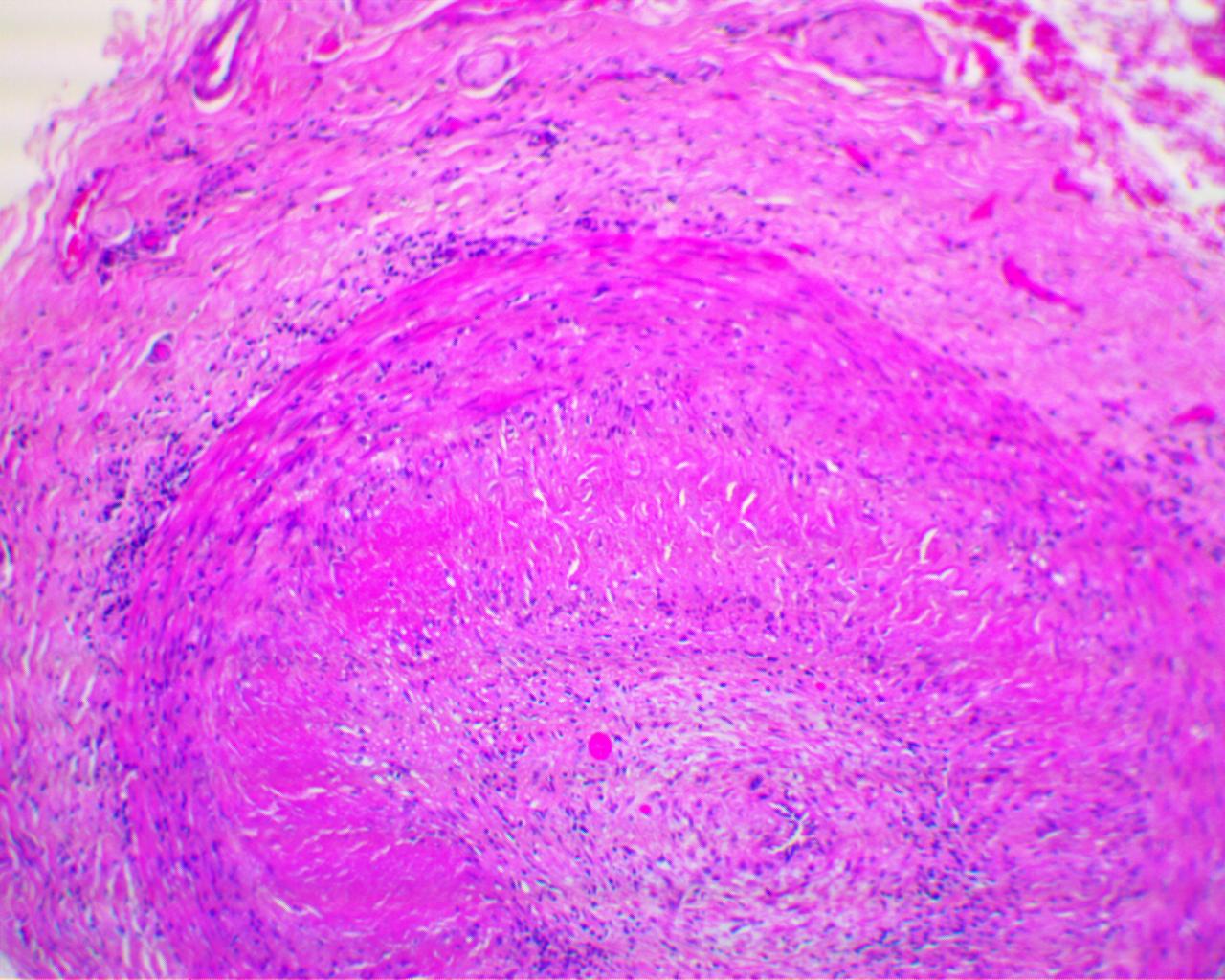 large-vessel-vasculitis-giant-cell-arteritis-and-takayasu-arteritis