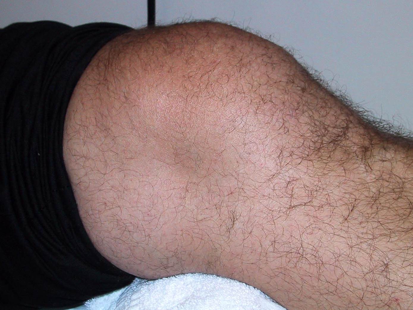 How Long Does Knee Effusion Last After Injury