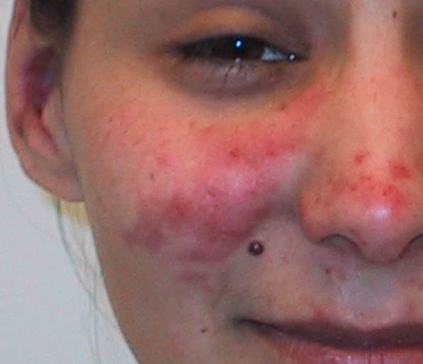 Interferons and Lupus Subsets | RheumNow