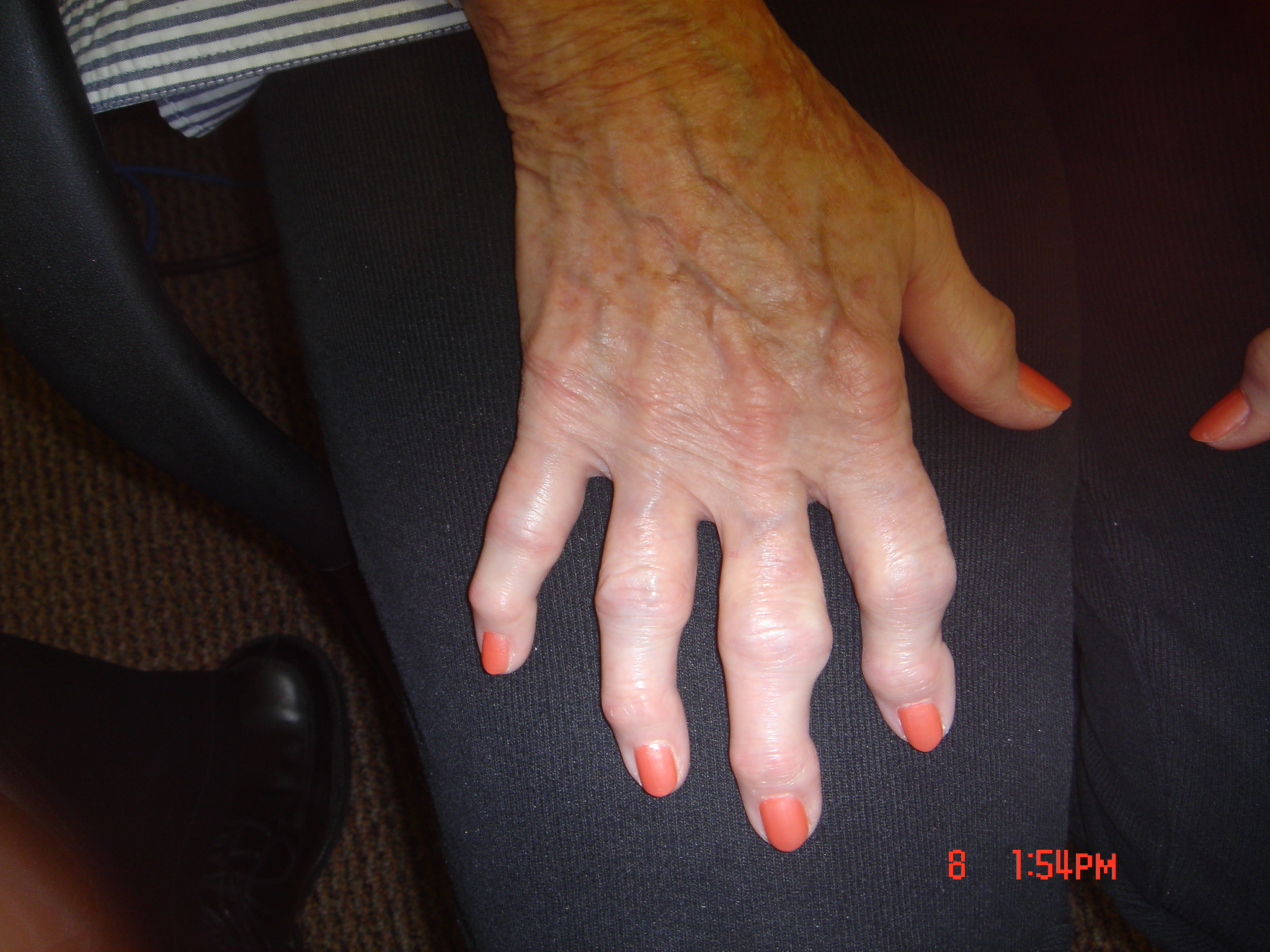 CDC Shows A 40% Lifetime Risk Of Symptomatic Hand Osteoarthritis | RheumNow