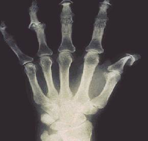 Guselkumab gets FDA Nod for X-ray Protection Save
