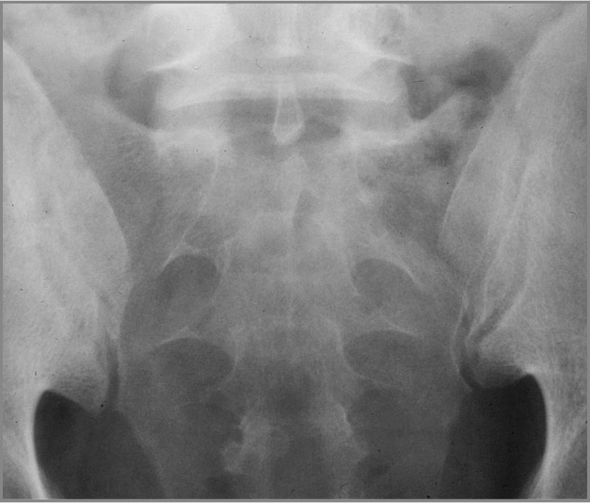 Taltz Shines In Non Radiographic Axial Spondyloarthritis Rheumnow