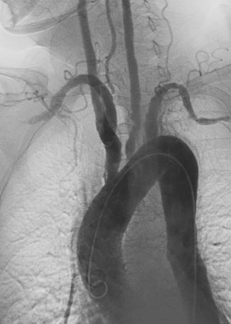 Noninfectious Proximal Aortitis Needs Serial Follow-ups 