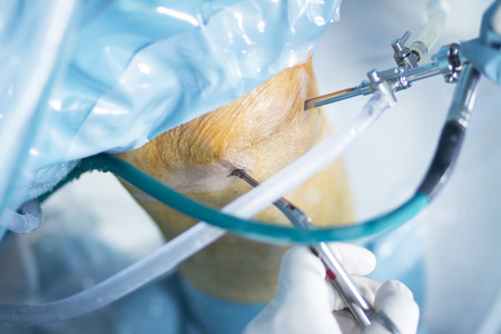 Knee Arthroscopic Surgeries On The Decline 