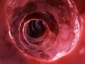 Early GI Involvement Predictive of Scleroderma Outcomes Save