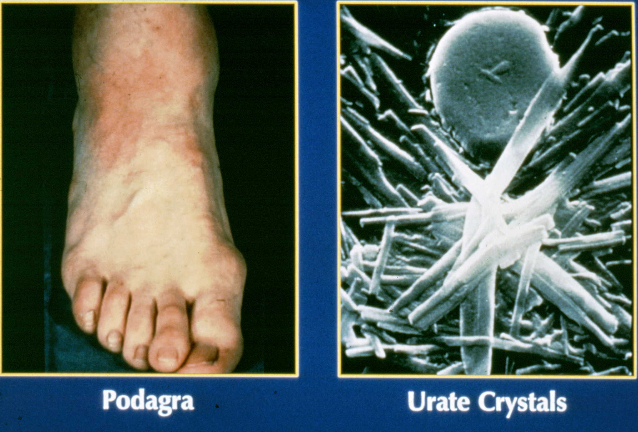 clinical presentation of gout and hyperuricemia