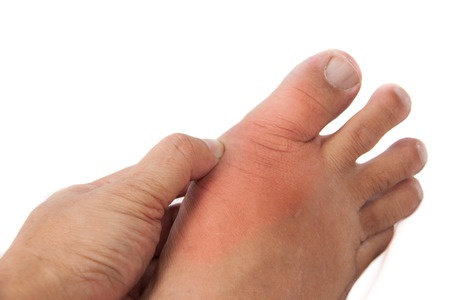 Lubricin as a Treatment Target in Gout? | RheumNow
