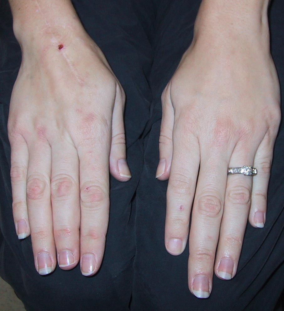 New ACR/AF Guidelines on JIA Polyarthritis and Uveitis RheumNow