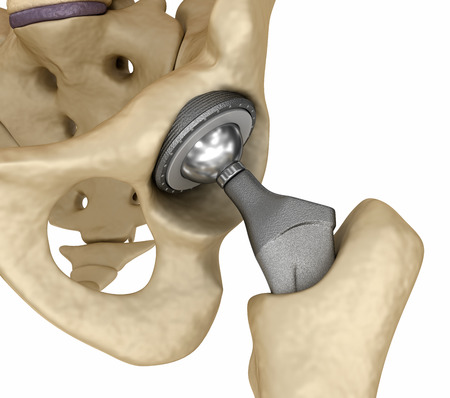 Hip Replacement Advances Save