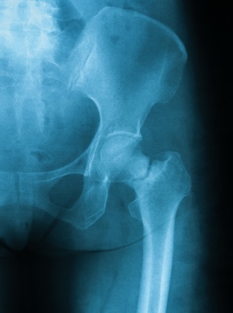 Fracture Risk with Osteoporosis Drug Holidays | RheumNow