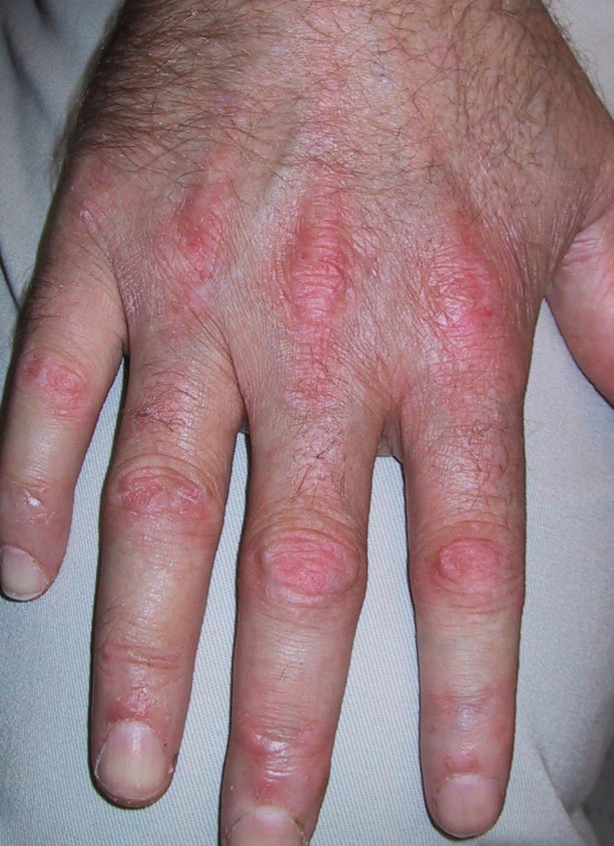 Calcineurin Inhibitors in AntiSynthetase Dermatomyositis ILD RheumNow