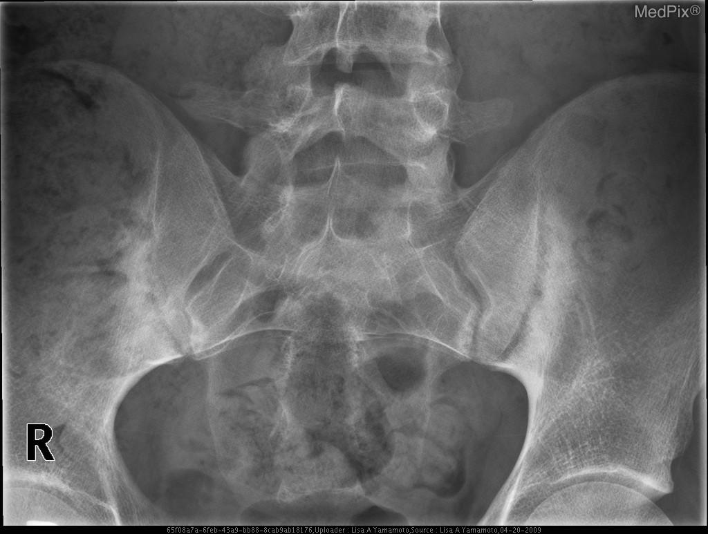 Prolonged TNF Inhibitor Use Delays Sacroiliac Progression | RheumNow