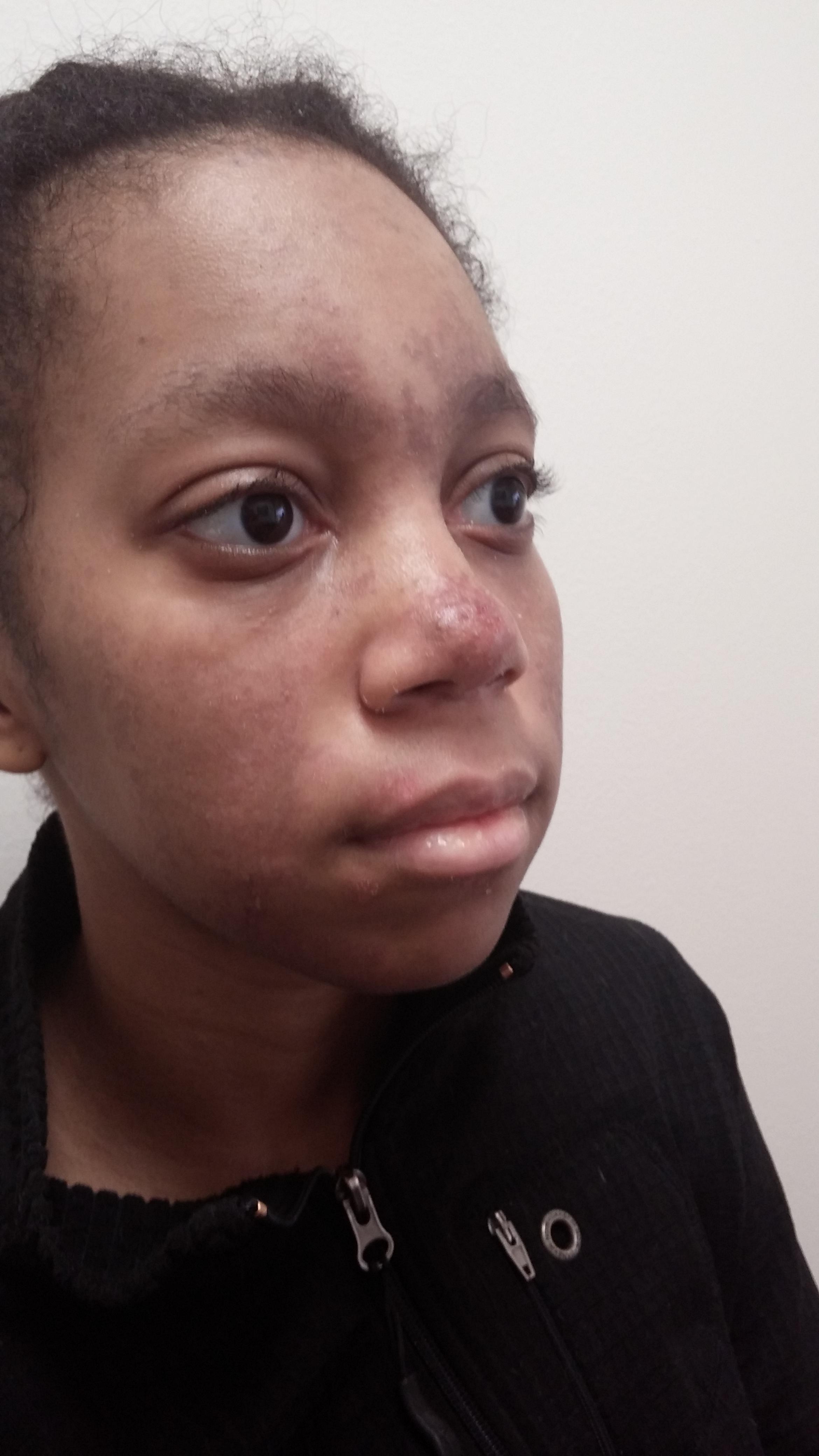 Damage in Childhood Lupus | RheumNow