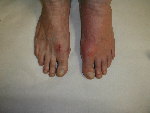 nice-guidelines-on-gout-diagnosis-and-management-rheumnow