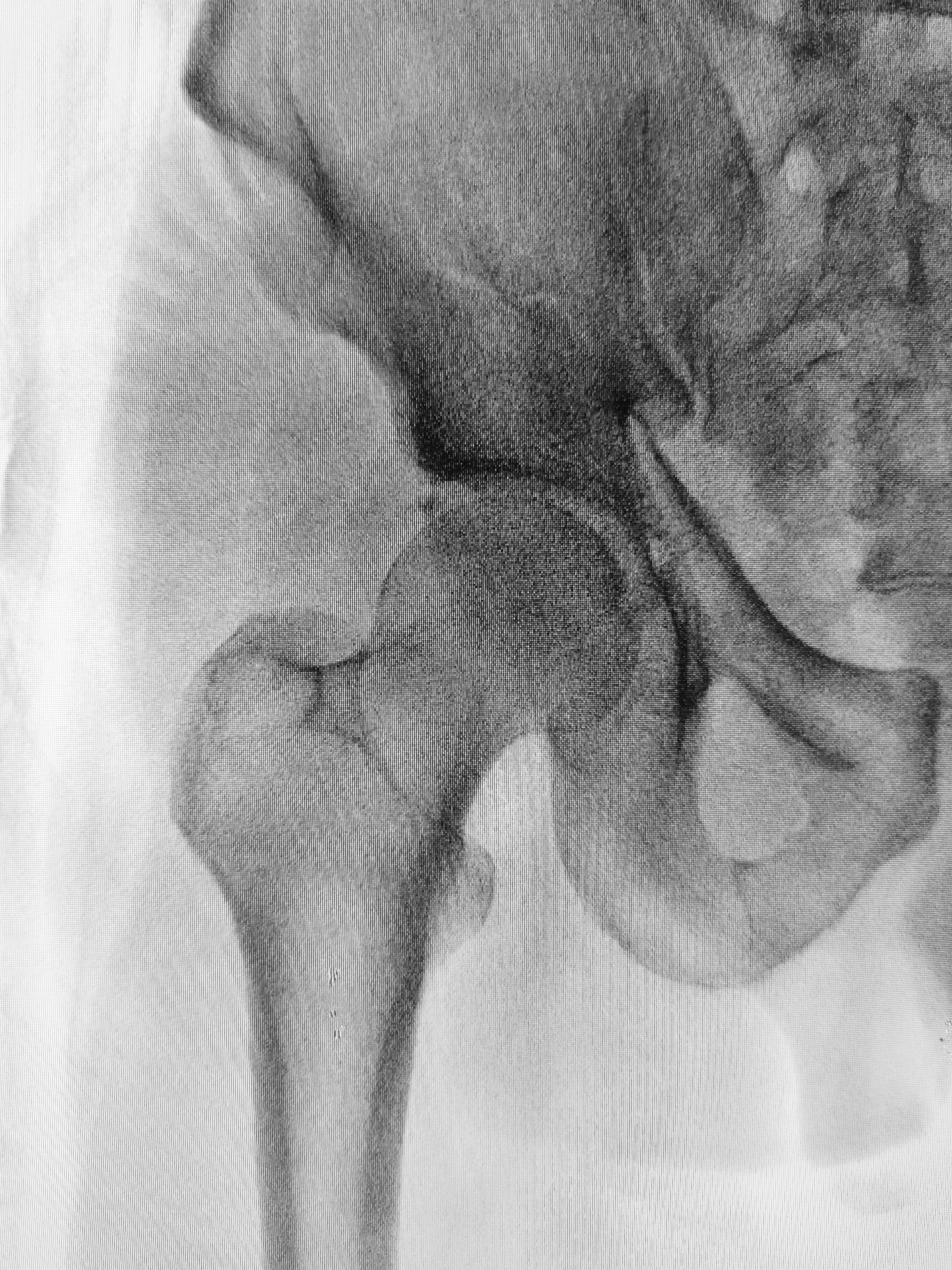 A Better Approach to Preventing Osteoporotic Fractures Save