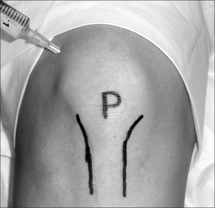 Glucocorticoid Injections in Knee Osteoarthritis | RheumNow