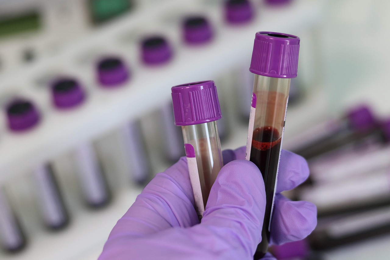 2-Gene Blood Test for Kawasaki Disease in Febrile Children Save