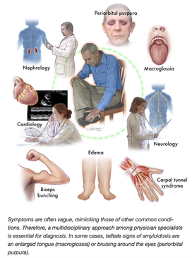 Review of Amyloidosis | RheumNow