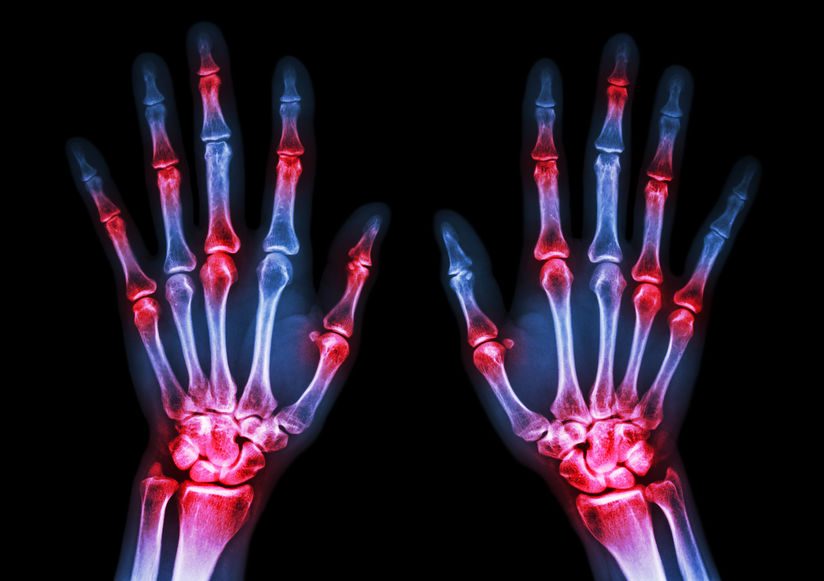 JAMA: Review of Adult Rheumatoid Arthritis Save
