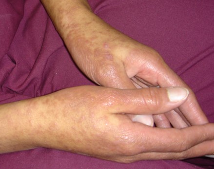Joint Disease in SLE Reconsidered Save