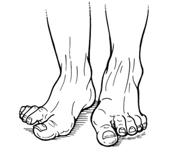 Surgery for 1st MTP Osteoarthritis Save