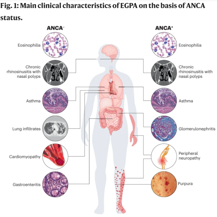 EGPA, guideline