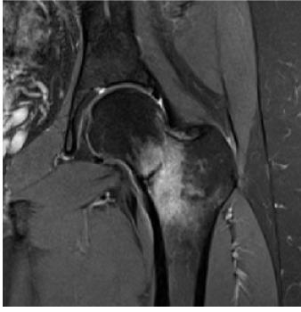 Femoral neck fracture