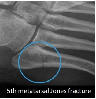 Jones Fracture