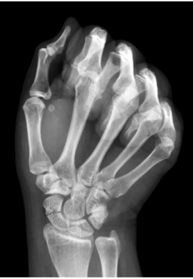 Scaphoid Fracture
