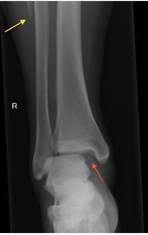 Maisonneuve fracture