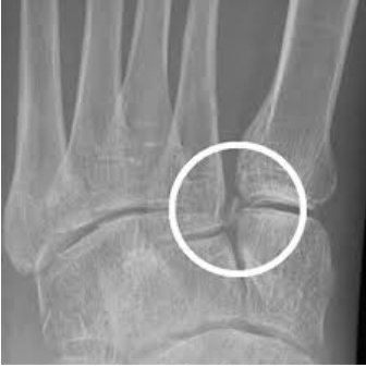 Lisfranc fracture