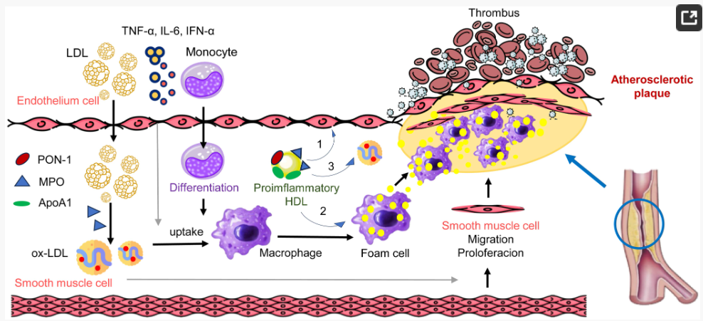  LDL passes through the endothelium.