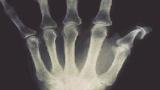 PsA.Xray_.Erosion.Cup_.jpg