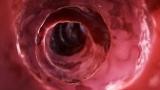 colitis.jpg