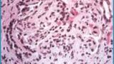 glomerulonephritis.GN_.lupus_.jpg