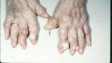 gout.tophi_.jpg