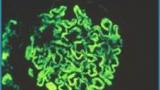 lupus.nephritis.immunofluorescence.jpg