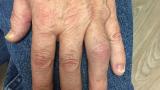 psoriatic.PIP_.JPG