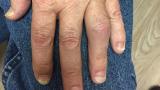 psoriatic.PIP_.JPG