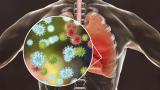 Covid lung pneumonia corona (keep)