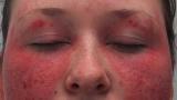 Malar,rash,SLE, Lupus