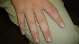 undifferentiated,arthritis,early,RA