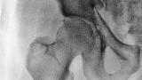 hip,fracture3